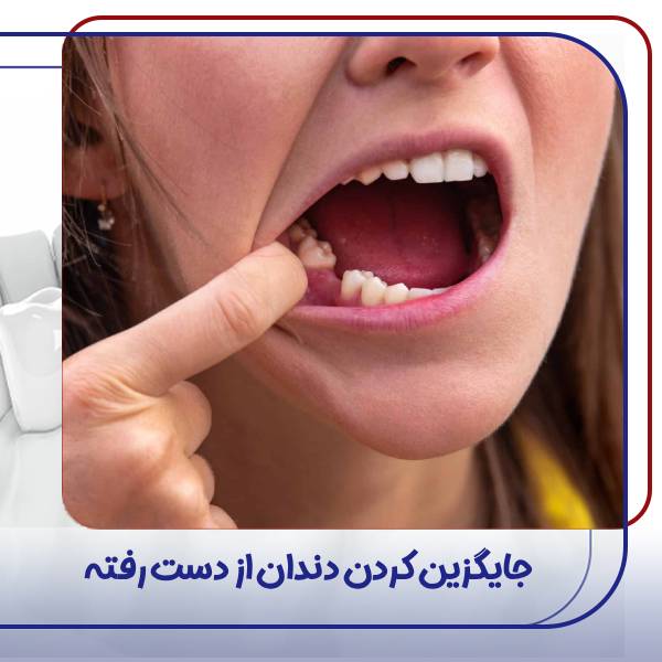 پر کردن دندان از دست رفته