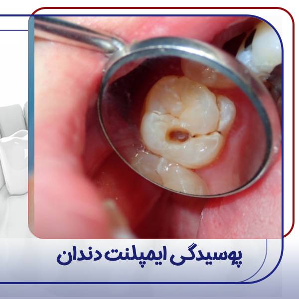 پوسیده شدن ایمپلنت دندان