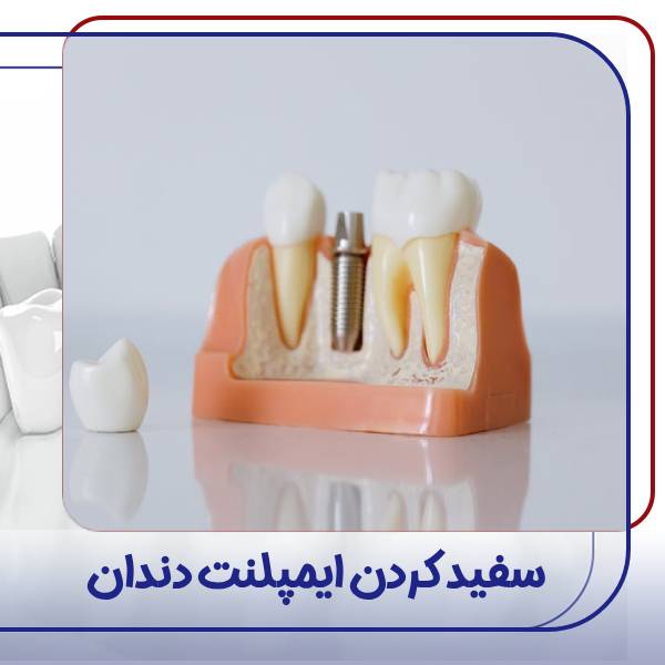 سفید کردن ایمپلنت دندان