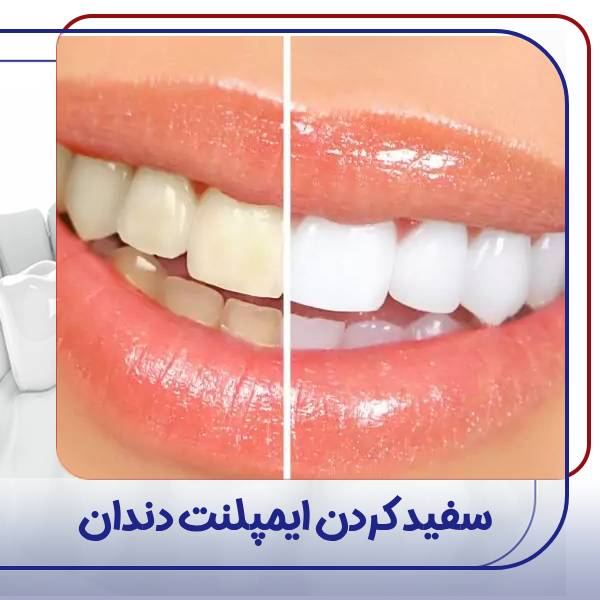 سفید کردن ایمپلنت دندان