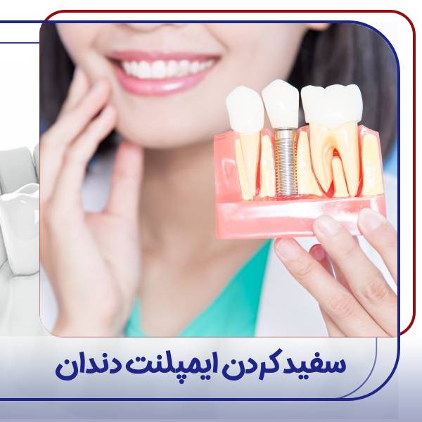 سفید کردن ایمپلنت دندان