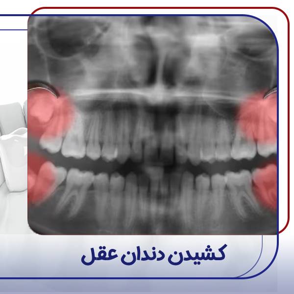 کشیدن دندان عقل