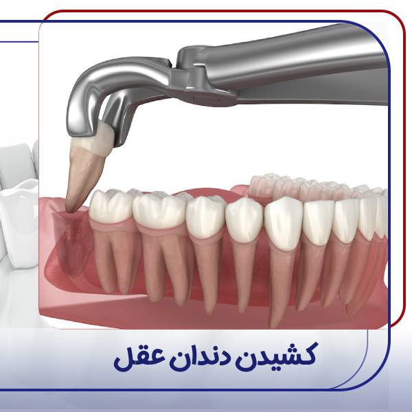 کشیدن دندان عقل