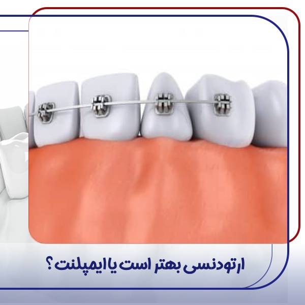 ایمپلنت بهتر است یا ارتودنسی