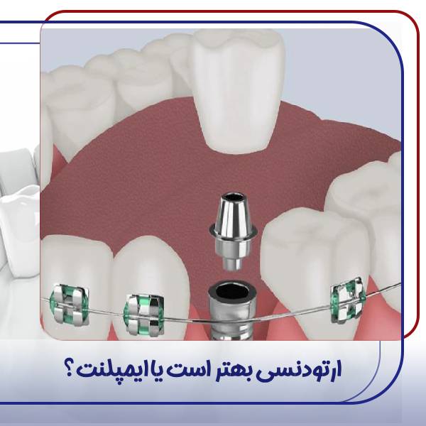 ایمپلنت دندان یا ارتودنسی