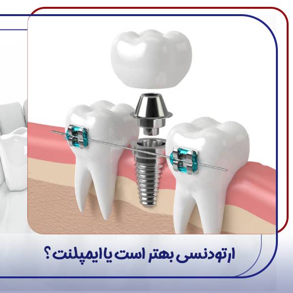ارتودنسی بهتر است یا ایمپلنت