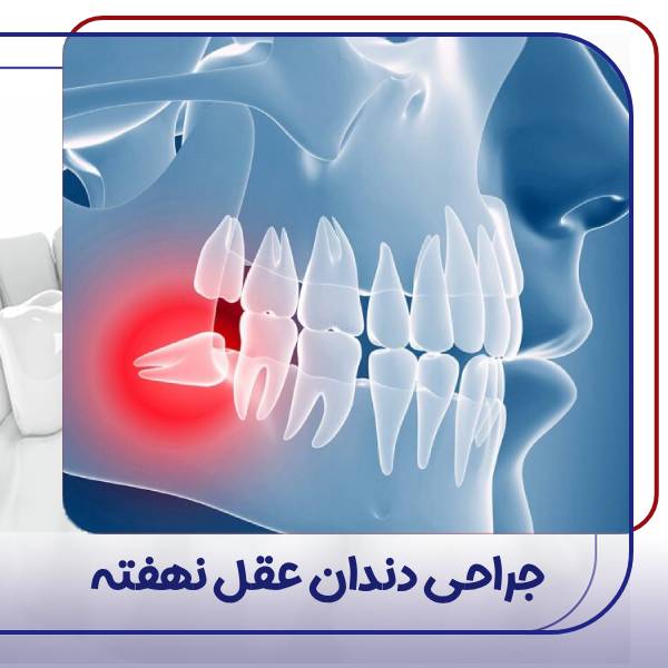عمل دندان عقل نهفته