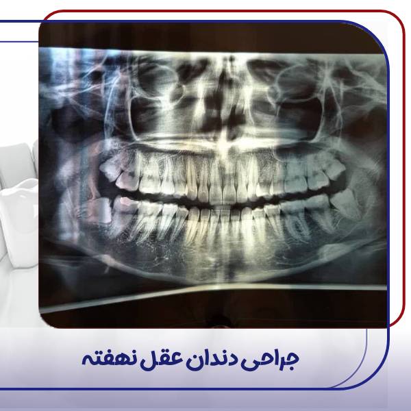 عکس جراحی دندان عقل نهفته