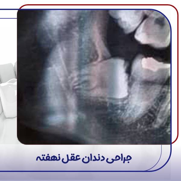 عمل جراحی دندان عقل نهفته