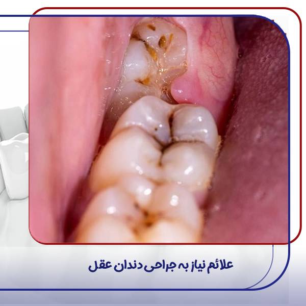 علائم نیاز به جراحی دندان عقل