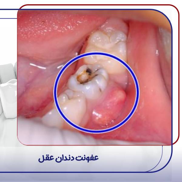 عفونت دندان عقل
