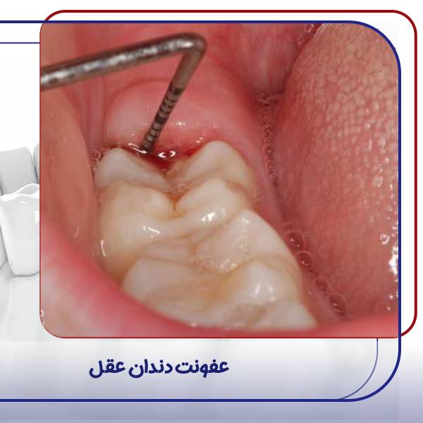 عفونت دندان عقل