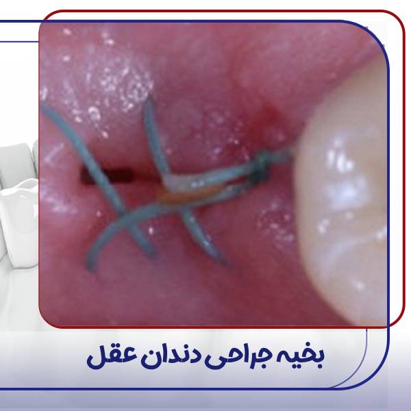 کشیدن بخیه جراحی دندان عقل