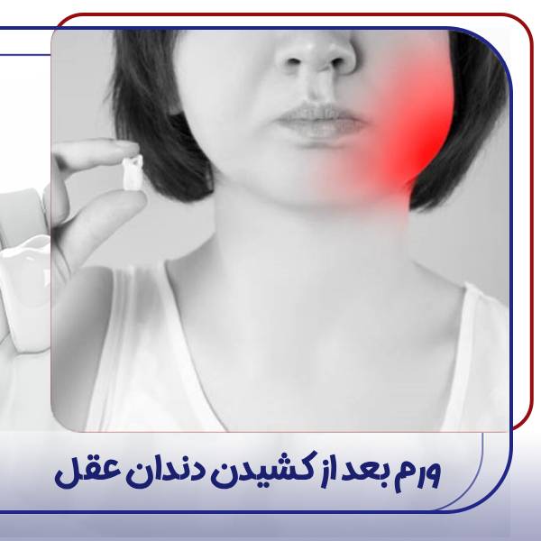 ورم صورت بعد از جراحی دندان عقل