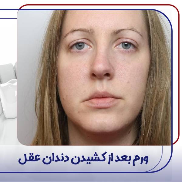 ورم صورت بعد از جراحی دندان عقل