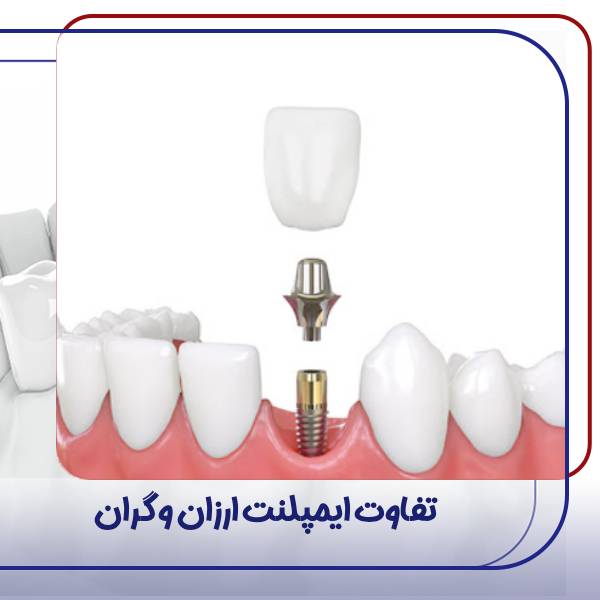 تفاوت ایمپلنت گران و ارزان