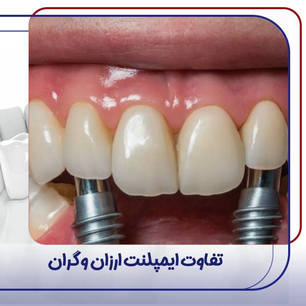 تفاوت ایمپلنت گران و ارزان