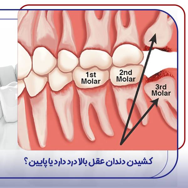 کشیدن دندان عقل بالا یا پایین؟