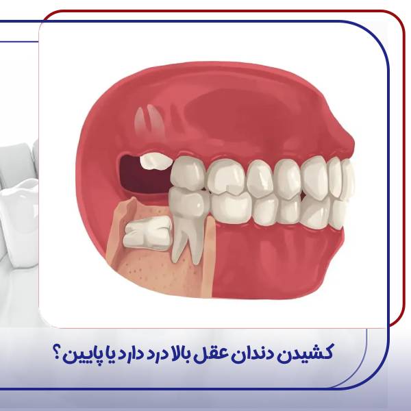 کشیدن دندان عقل بالا یا پایین؟