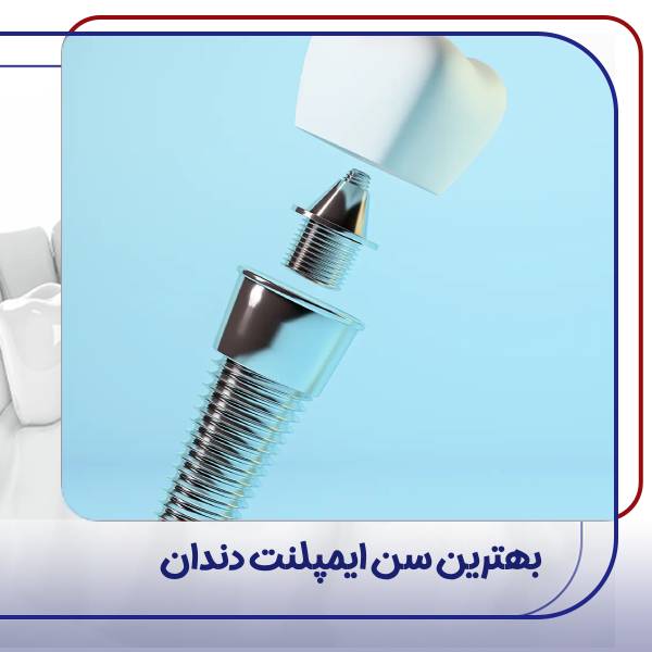 بهترین سن ایمپلنت دندان