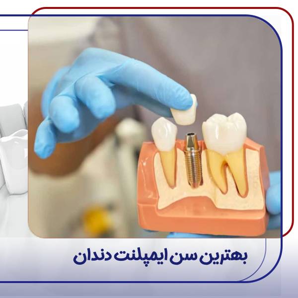 بهترین سن ایمپلنت دندان